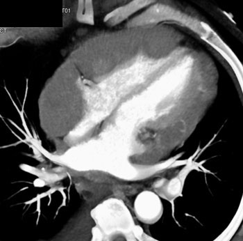 cardiac 64 mdct