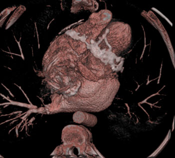 cardiac 64 mdct