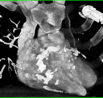 cardiac 64 mdct