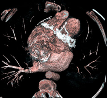 cardiac 64 mdct