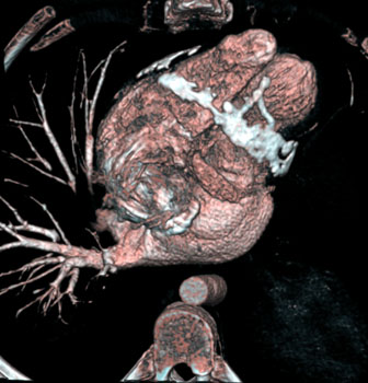 cardiac 64 mdct