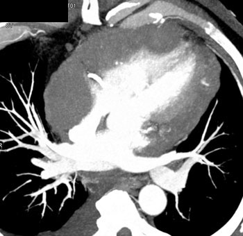 cardiac 64 mdct