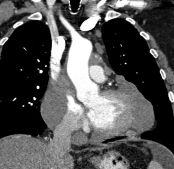 cardiac 64 mdct