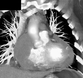 cardiac 64 mdct