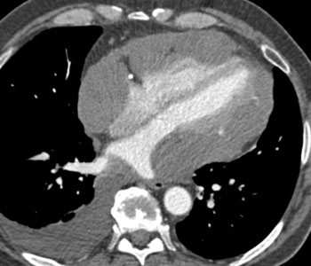 cardiac 64 mdct