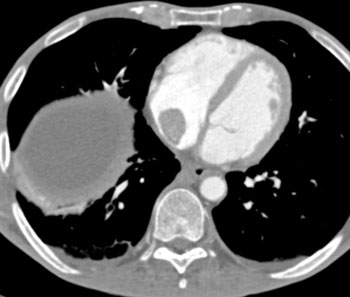 cardiac 64 mdct