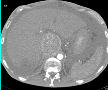 cardiac 64 mdct