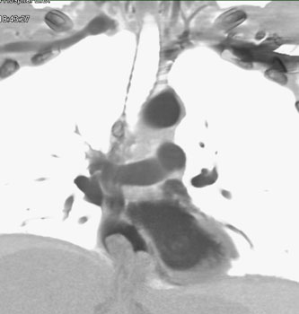 cardiac 64 mdct