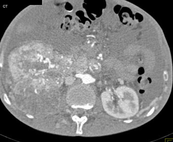 cardiac 64 mdct