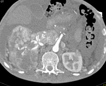 cardiac 64 mdct