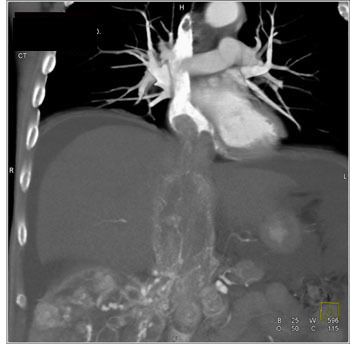 cardiac 64 mdct