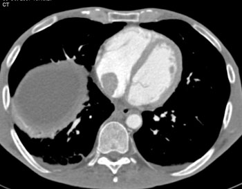 cardiac 64 mdct