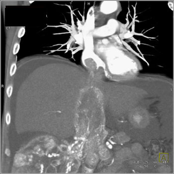 cardiac 64 mdct