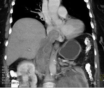 cardiac 64 mdct