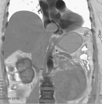 cardiac 64 mdct