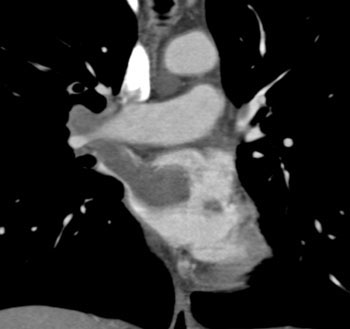 cardiac 64 mdct