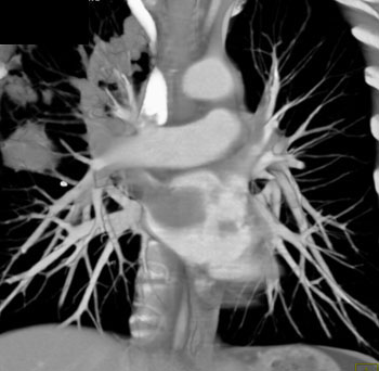 cardiac 64 mdct