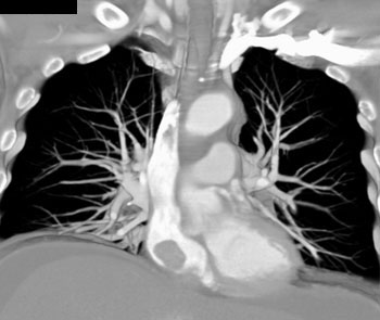 cardiac 64 mdct