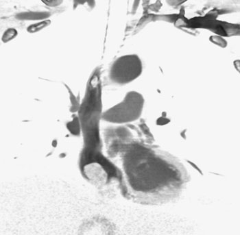 cardiac 64 mdct