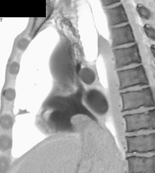 cardiac 64 mdct