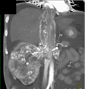 cardiac 64 mdct