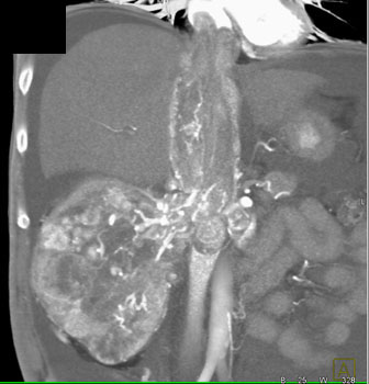 cardiac 64 mdct