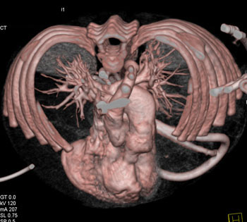 cardiac 64 mdct