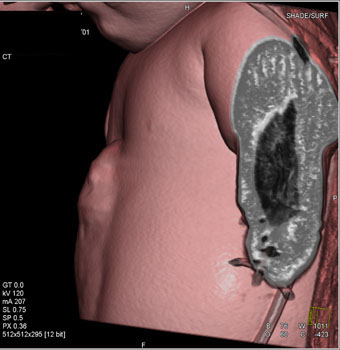 cardiac 64 mdct