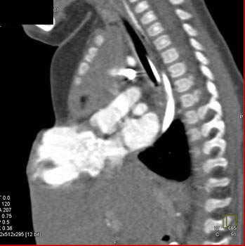 cardiac 64 mdct