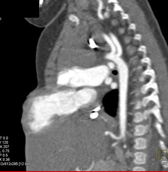 cardiac 64 mdct