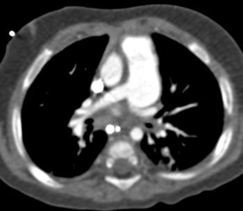 cardiac 64 mdct