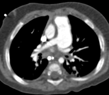 cardiac 64 mdct