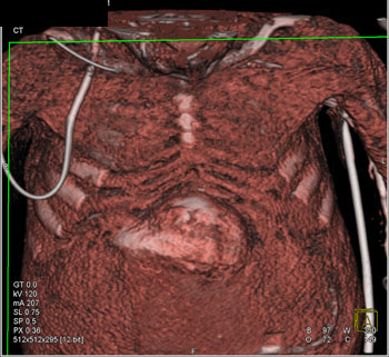 cardiac 64 mdct