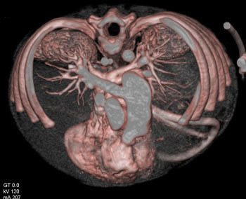 cardiac 64 mdct