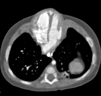 cardiac 64 mdct