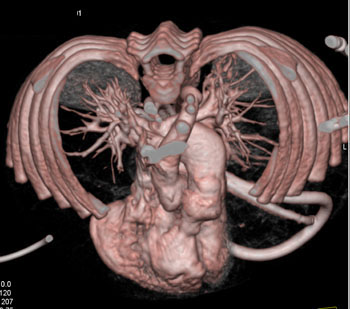 cardiac 64 mdct