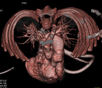 cardiac 64 mdct