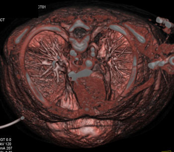 cardiac 64 mdct