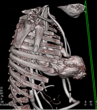 cardiac 64 mdct