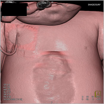 cardiac 64 mdct