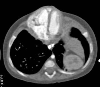 cardiac 64 mdct