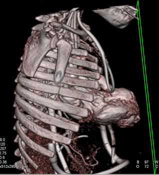 cardiac 64 mdct