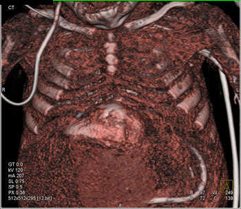 cardiac 64 mdct