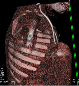 cardiac 64 mdct