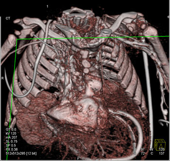 cardiac 64 mdct