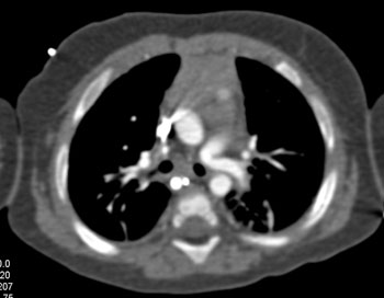 cardiac 64 mdct