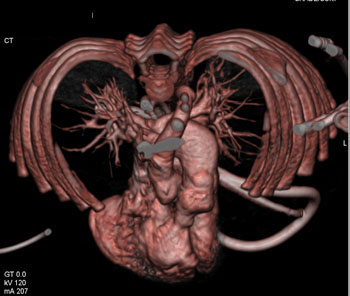 cardiac 64 mdct