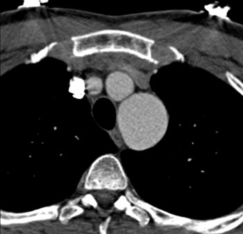 cardiac 64 mdct