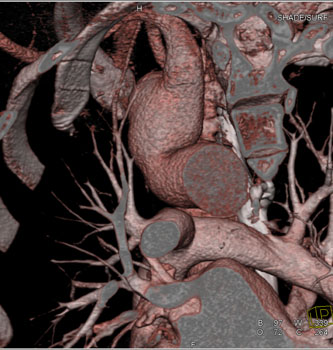 cardiac 64 mdct