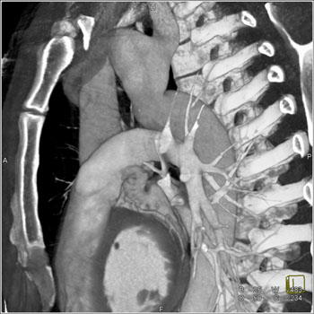 cardiac 64 mdct